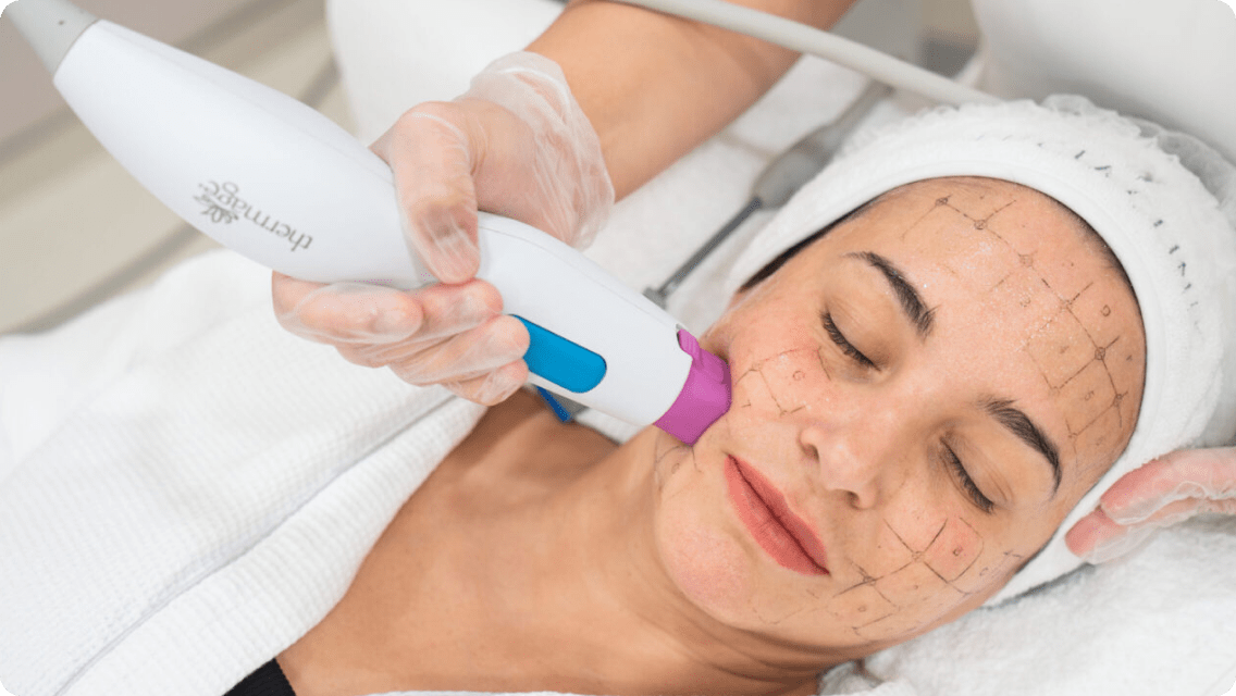 thermage-treatment-for-face